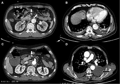 Clinical characteristics and outcomes of Stanford type B aortic intramural hematoma: A single centre experience